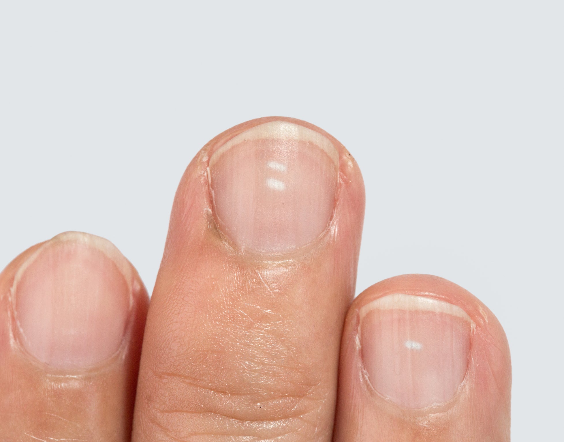Witte vlekken op nagels
