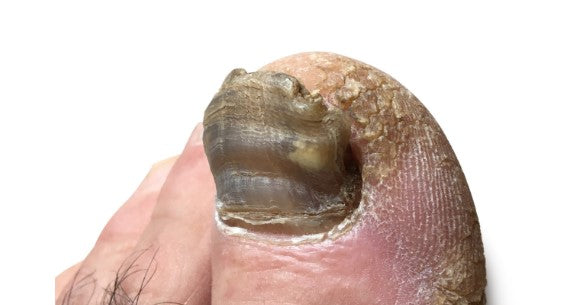 Lelijke Nagels: Oorzaken en Behandelingen | Supplend