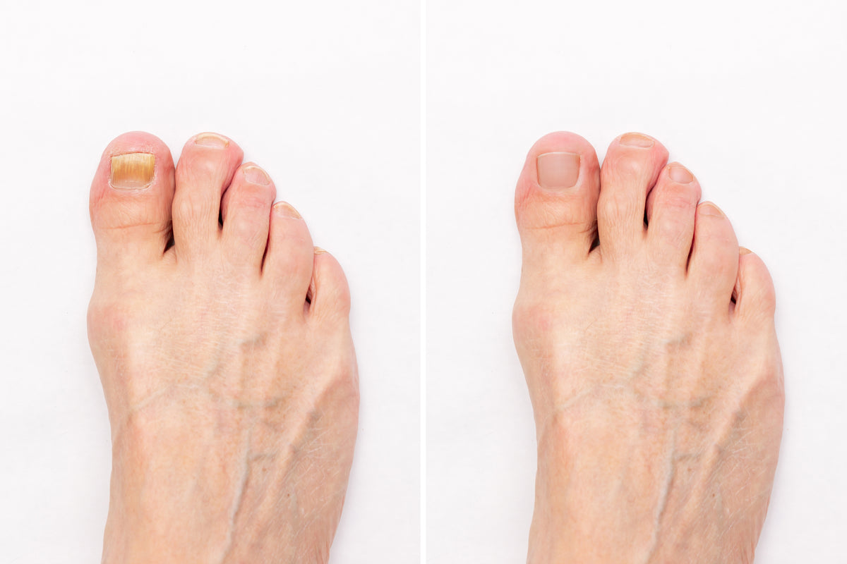 Gele nagels: Oorzaken, behandel en voorkom je Gele Nagels